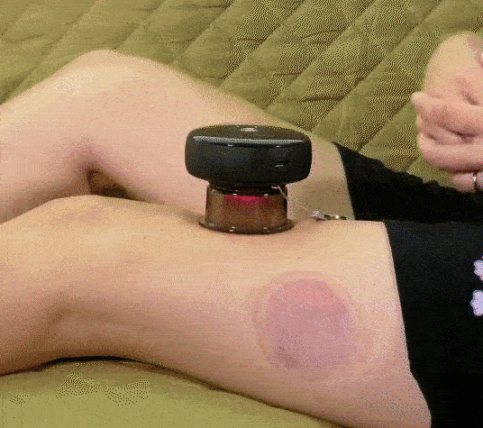 Masajeador Inteligente de Cupping